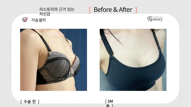 Breast surgery: patient photo comparison · 068 at Restory Plastic Surgery Clinic. Front view. Before on the left; after on the right. The photographs show the breast outline, position and upper fullness. The after photograph is labelled 3 months.