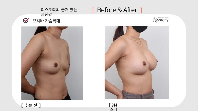 Motiva breast augmentation · 069 at Restory Plastic Surgery Clinic. Angled view. Before on the left; after on the right. The photographs show the breast outline, position and upper fullness. The after photograph is labelled 3 months.
