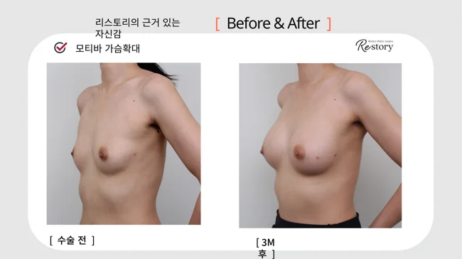 Motiva breast augmentation · 070 at Restory Plastic Surgery Clinic. Angled view. Before on the left; after on the right. The photographs show the breast outline, position and upper fullness. The after photograph is labelled 3 months.