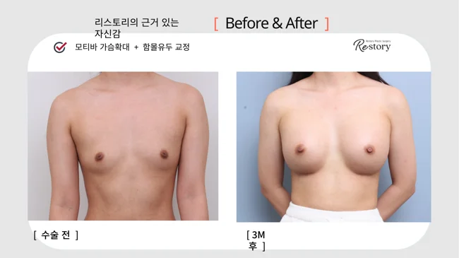 Motiva breast augmentation with inverted-nipple correction · 071 at Restory Plastic Surgery Clinic. Front view. Before on the left; after on the right. The photographs show the breast outline, position and upper fullness. The after photograph is labelled 3 months.