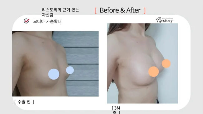 Motiva breast augmentation · 072 at Restory Plastic Surgery Clinic. Angled view. Before on the left; after on the right. The photographs show the breast outline, position and upper fullness. The after photograph is labelled 3 months.