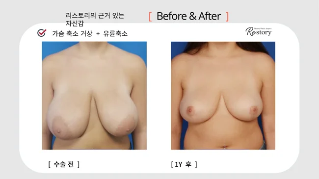 Breast reduction and lift with areola reduction · 073 at Restory Plastic Surgery Clinic. Front view. Before on the left; after on the right. The photographs show the breast outline, position and upper fullness. The after photograph is labelled 1 year.