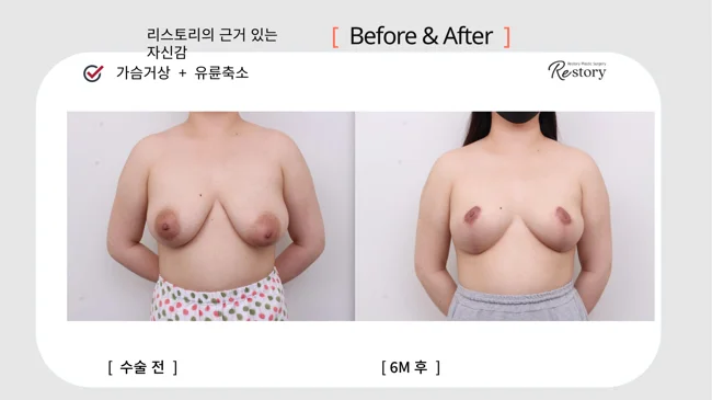 Breast lift with areola reduction · 074 at Restory Plastic Surgery Clinic. Front view. Before on the left; after on the right. The photographs show the breast outline, position and upper fullness. The after photograph is labelled 6 months.