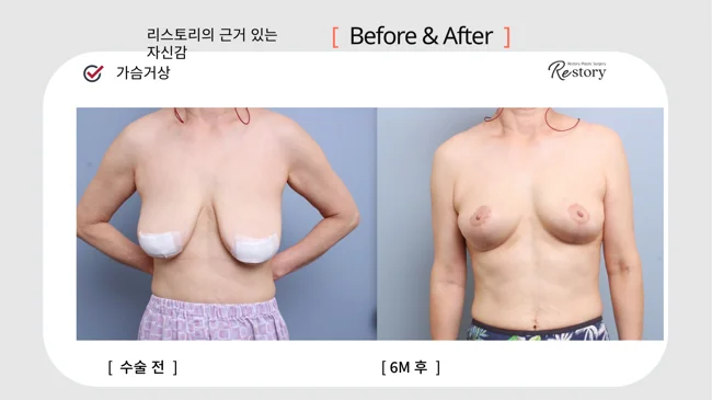 Breast lift · 075 at Restory Plastic Surgery Clinic. Front view. Before on the left; after on the right. The photographs show the breast outline, position and upper fullness. The after photograph is labelled 6 months.