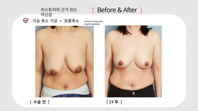 Breast reduction and lift: timing labels differ · 076 at Restory Plastic Surgery Clinic. Front view. Before on the left; after on the right. The photographs show the breast outline, position and upper fullness. The slide labels the after image as one year, but also contains “10mo”; confirm the timing with the clinic.