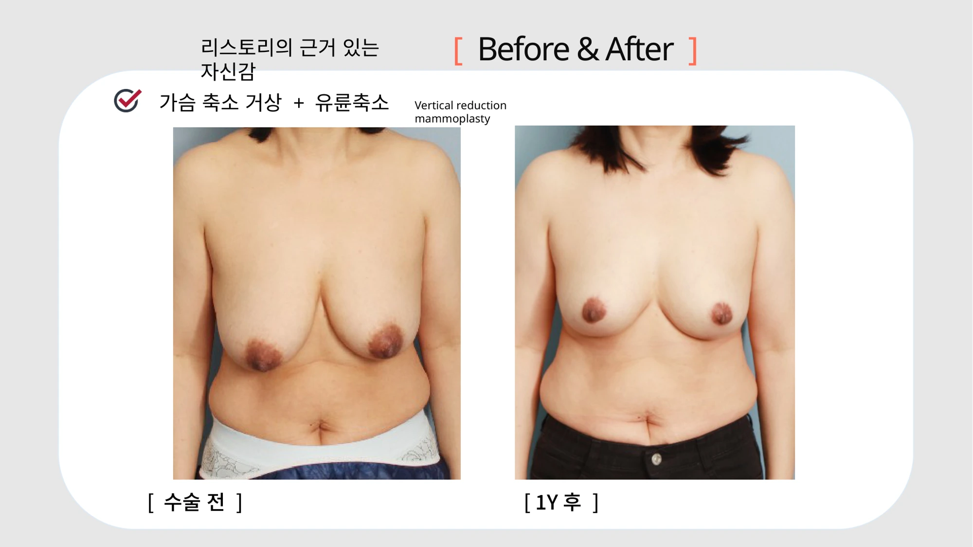 Breast reduction and lift: timing labels differ · 076 at Restory Plastic Surgery Clinic. Front view. Before on the left; after on the right. The photographs show the breast outline, position and upper fullness. The slide labels the after image as one year, but also contains “10mo”; confirm the timing with the clinic.