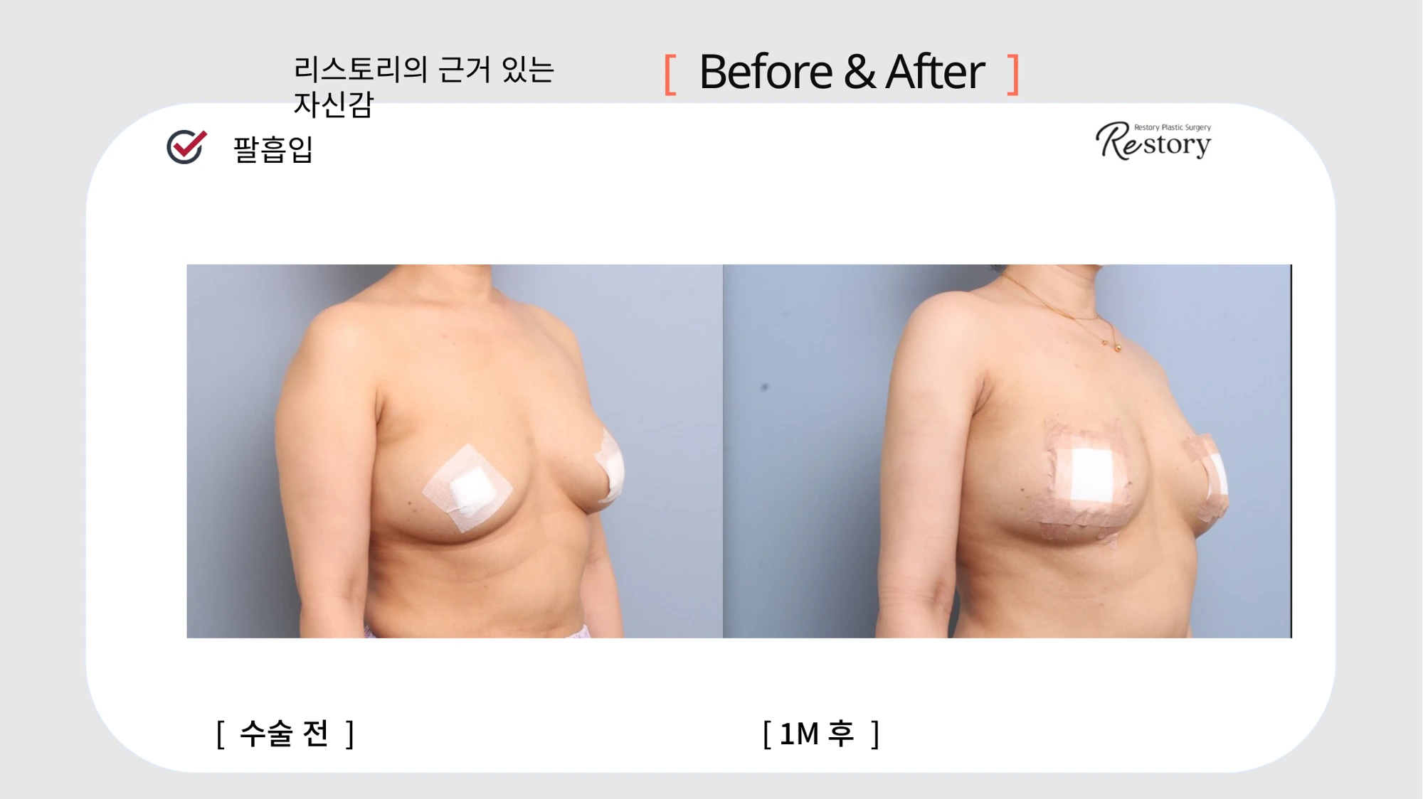 Upper-arm liposuction · 077 at Restory Plastic Surgery Clinic. Angled upper-body view. Before on the left; after on the right. The photographs show the contours of the body area named in the treatment. The after photograph is labelled 1 month.