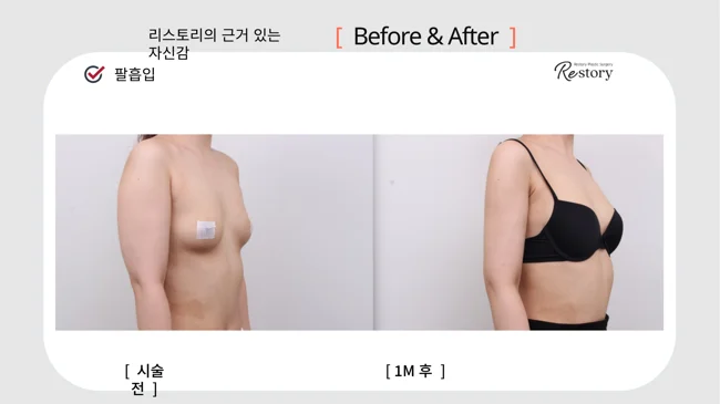 Upper-arm liposuction · 078 at Restory Plastic Surgery Clinic. Side view. Before on the left; after on the right. The photographs show the contours of the body area named in the treatment. The after photograph is labelled 1 month.