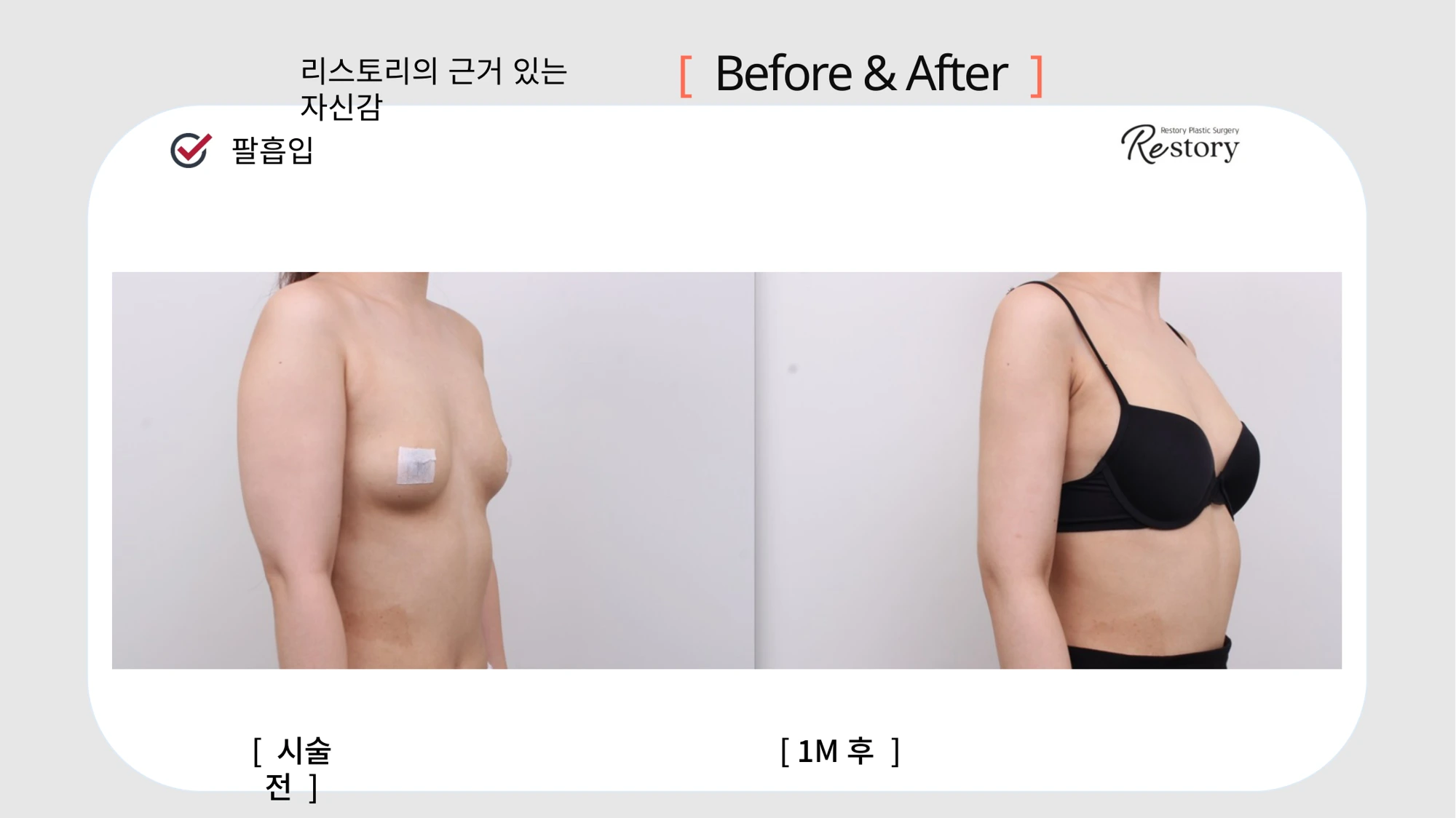 Upper-arm liposuction · 078 at Restory Plastic Surgery Clinic. Side view. Before on the left; after on the right. The photographs show the contours of the body area named in the treatment. The after photograph is labelled 1 month.