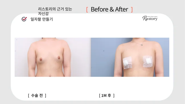 Upper-arm contouring · 079 at Restory Plastic Surgery Clinic. Front upper-body view. Before on the left; after on the right. The photographs show the contours of the body area named in the treatment. The after photograph is labelled 1 month.