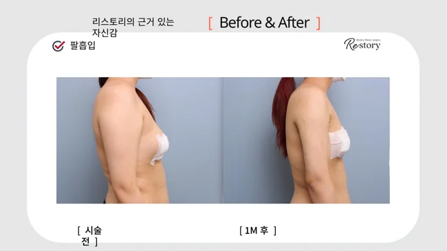 Upper-arm liposuction · 080 at Restory Plastic Surgery Clinic. Side view. Before on the left; after on the right. The photographs show the contours of the body area named in the treatment. The after photograph is labelled 1 month.