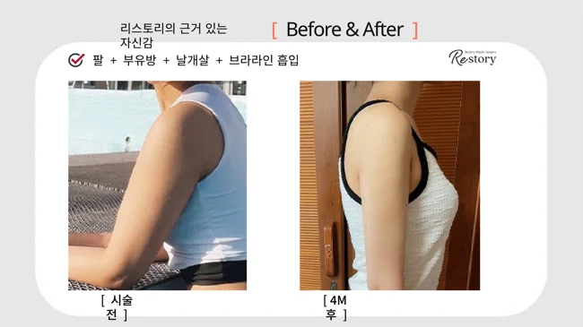Arm, underarm, back and bra-line liposuction · 081 at Restory Plastic Surgery Clinic. Side upper-body view. Before on the left; after on the right. The photographs show the contours of the body area named in the treatment. The after photograph is labelled 4 months.