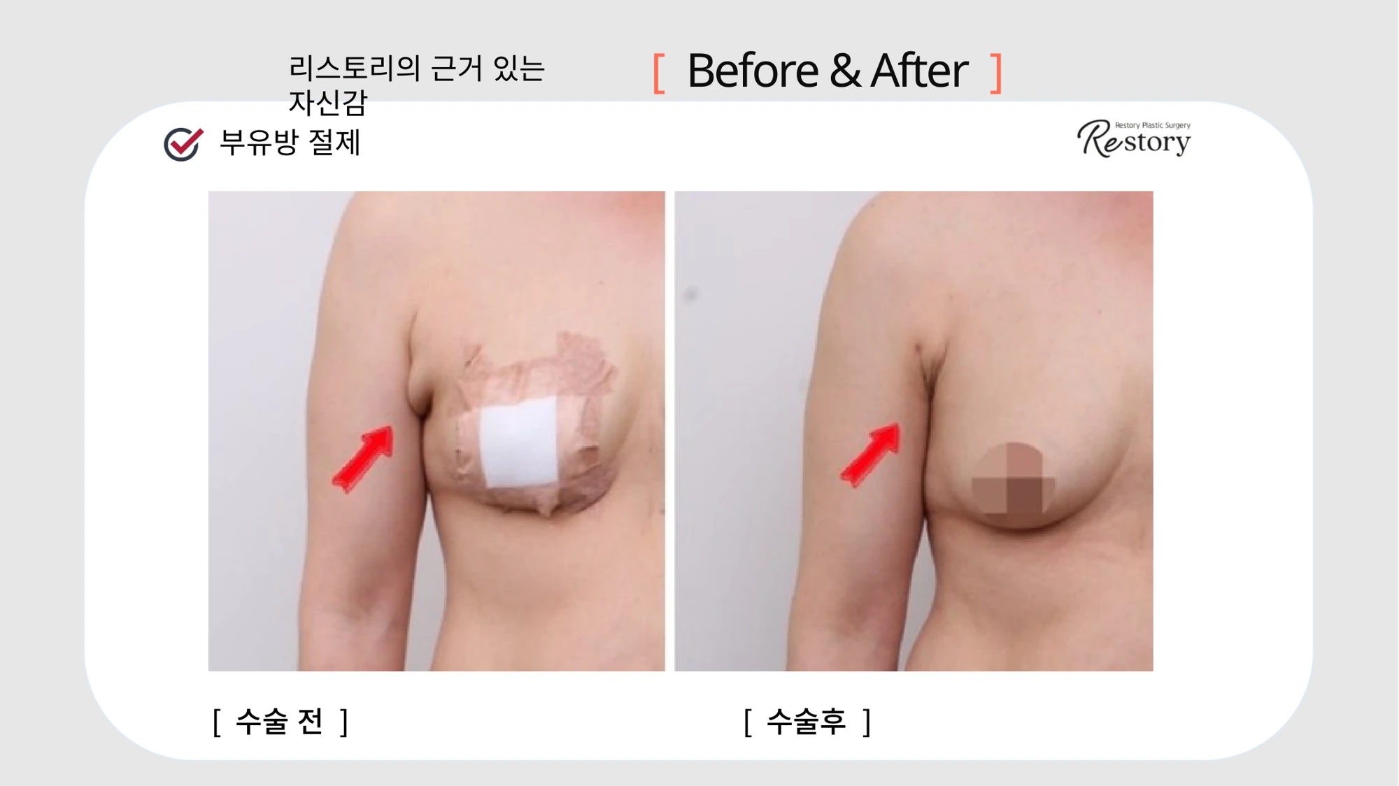 Accessory breast tissue excision · 082 at Restory Plastic Surgery Clinic. Underarm close-up. Before on the left; after on the right. The photographs show the contours of the body area named in the treatment. The follow-up interval is not stated.