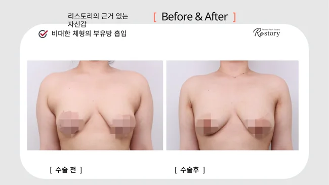Accessory breast tissue liposuction · 083 at Restory Plastic Surgery Clinic. Front upper-body view. Before on the left; after on the right. The photographs show the contours of the body area named in the treatment. The follow-up interval is not stated.