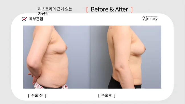 Abdominal liposuction · 084 at Restory Plastic Surgery Clinic. Side view. Before on the left; after on the right. The photographs show the contours of the body area named in the treatment. The follow-up interval is not stated.