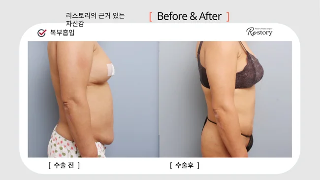 Abdominal liposuction · 085 at Restory Plastic Surgery Clinic. Side view. Before on the left; after on the right. The photographs show the contours of the body area named in the treatment. The follow-up interval is not stated.