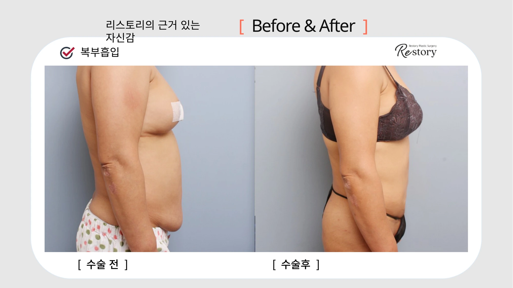Abdominal liposuction · 085 at Restory Plastic Surgery Clinic. Side view. Before on the left; after on the right. The photographs show the contours of the body area named in the treatment. The follow-up interval is not stated.