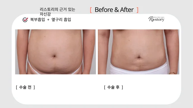 Abdominal and flank liposuction · 086 at Restory Plastic Surgery Clinic. Front abdominal view. Before on the left; after on the right. The photographs show the contours of the body area named in the treatment. The follow-up interval is not stated.