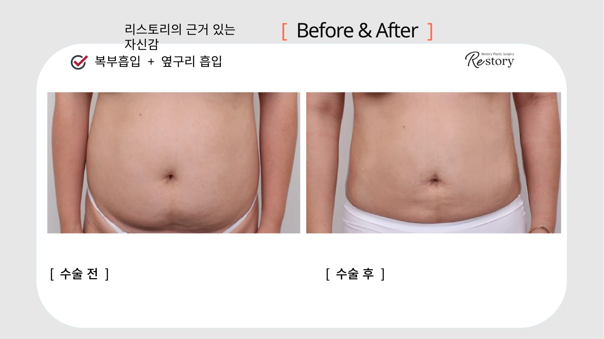 Abdominal and flank liposuction · 086 at Restory Plastic Surgery Clinic. Front abdominal view. Before on the left; after on the right. The photographs show the contours of the body area named in the treatment. The follow-up interval is not stated.