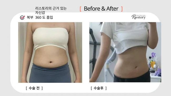 360-degree abdominal liposuction · 087 at Restory Plastic Surgery Clinic. Everyday abdominal photographs. Before on the left; after on the right. The photographs show the contours of the body area named in the treatment. The follow-up interval is not stated.