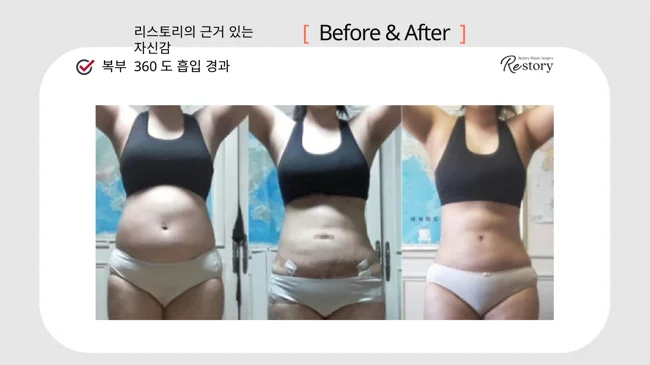 360-degree abdominal liposuction: photo sequence · 088 at Restory Plastic Surgery Clinic. Three-photo abdominal sequence. Three photographs presented in sequence; individual intervals are not labelled. The photographs show the contours of the body area named in the treatment. The follow-up interval is not stated.