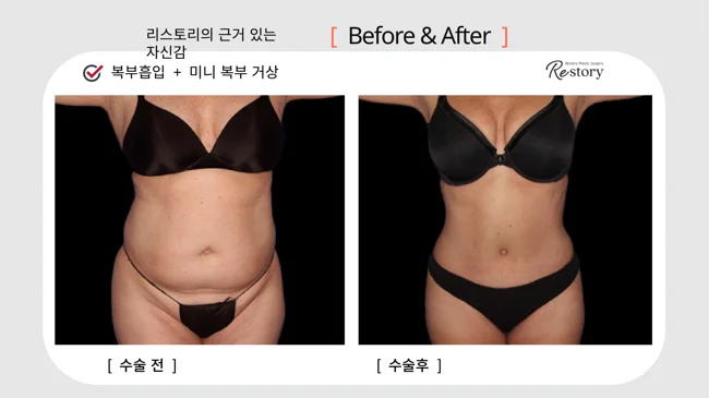 Abdominal liposuction with mini tummy tuck · 089 at Restory Plastic Surgery Clinic. Front abdominal view. Before on the left; after on the right. The photographs show the abdominal contour, waist and lower abdominal skin. The follow-up interval is not stated.
