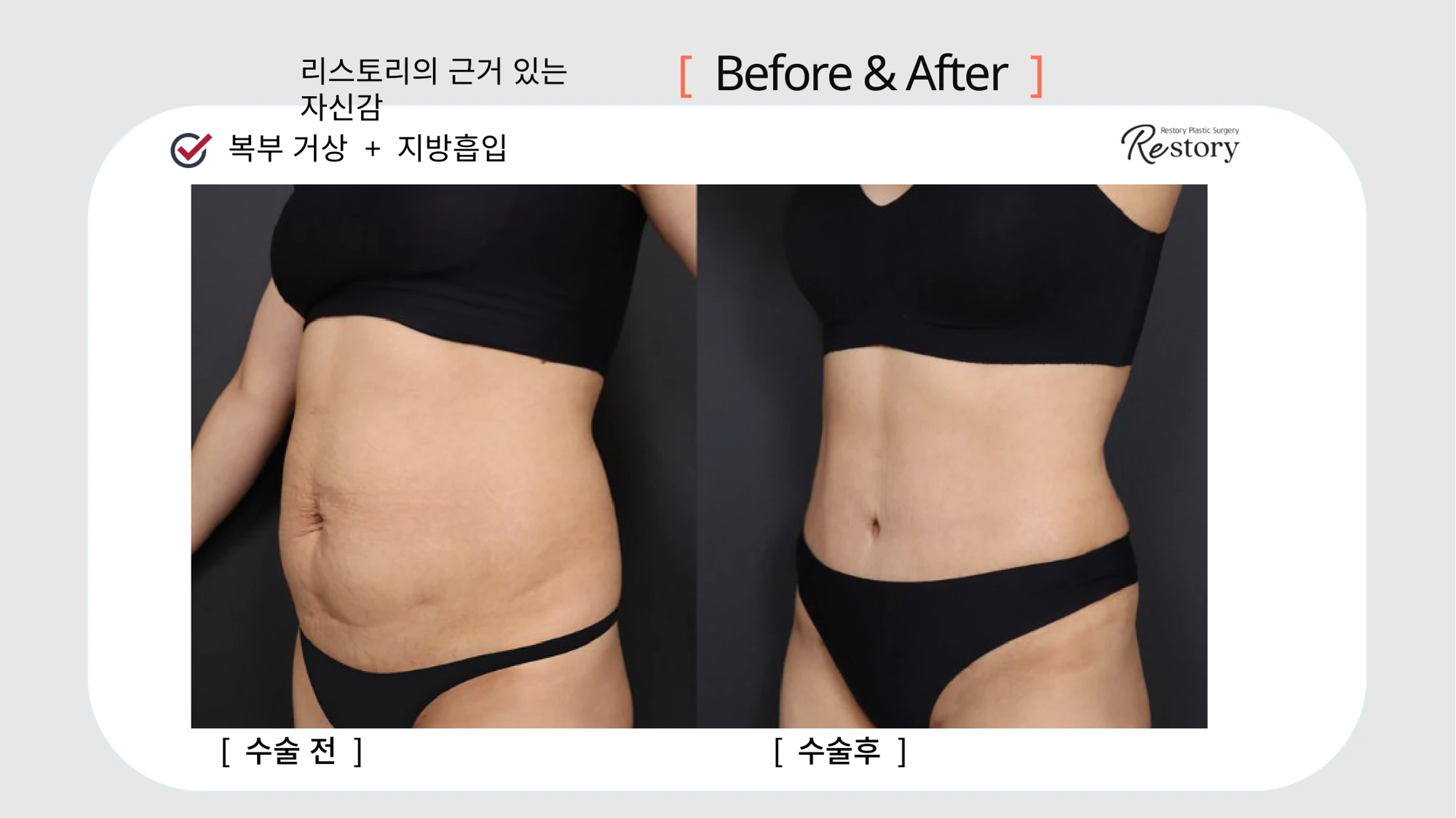 Tummy tuck with liposuction · 090 at Restory Plastic Surgery Clinic. Angled abdominal view. Before on the left; after on the right. The photographs show the abdominal contour, waist and lower abdominal skin. The follow-up interval is not stated.