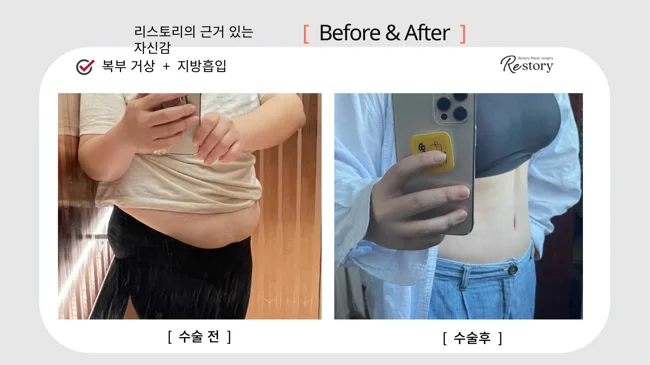 Tummy tuck with liposuction · 091 at Restory Plastic Surgery Clinic. Everyday abdominal photographs. Before on the left; after on the right. The photographs show the abdominal contour, waist and lower abdominal skin. The follow-up interval is not stated.