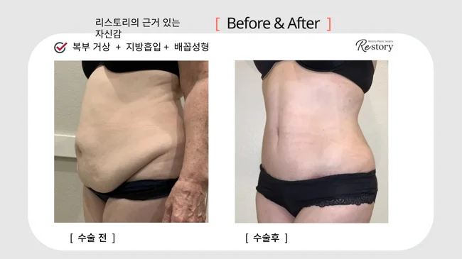 Tummy tuck, liposuction and belly-button reshaping · 092 at Restory Plastic Surgery Clinic. Front abdominal view. Before on the left; after on the right. The photographs show the abdominal contour, waist and lower abdominal skin. The follow-up interval is not stated.