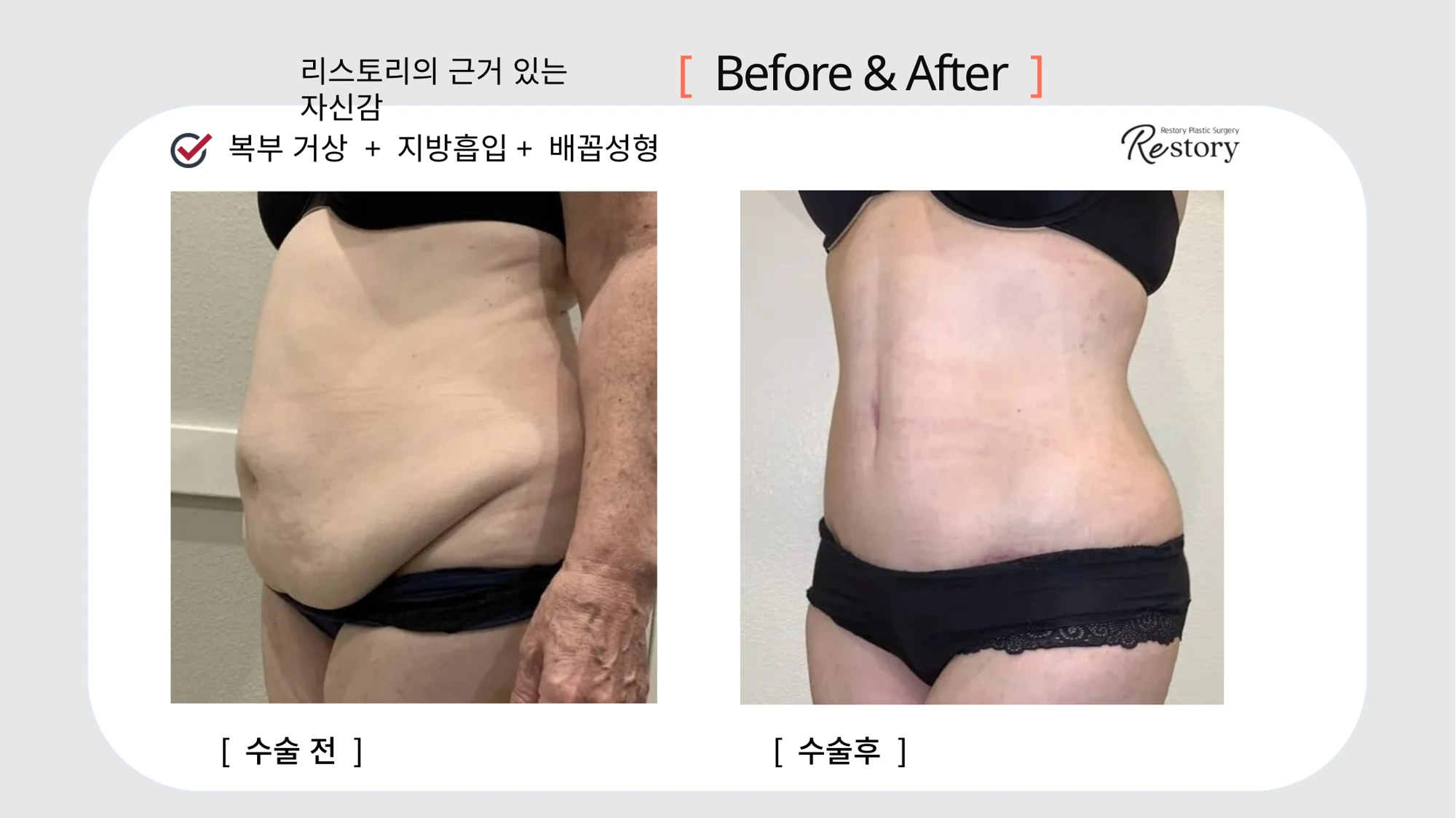 Tummy tuck, liposuction and belly-button reshaping · 092 at Restory Plastic Surgery Clinic. Front abdominal view. Before on the left; after on the right. The photographs show the abdominal contour, waist and lower abdominal skin. The follow-up interval is not stated.