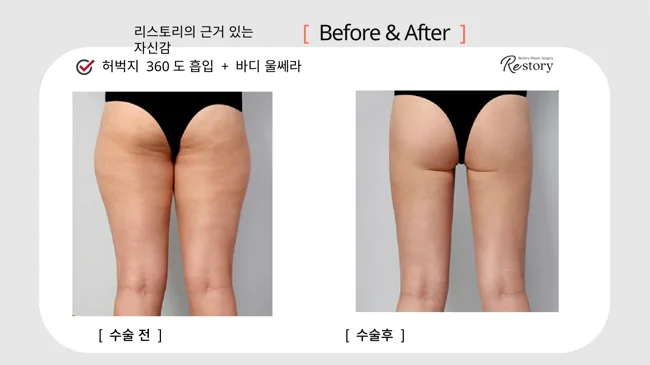 360-degree thigh liposuction with body Ultherapy · 093 at Restory Plastic Surgery Clinic. Rear thigh view. Before on the left; after on the right. The photographs show the inner and outer thigh contours. The follow-up interval is not stated.