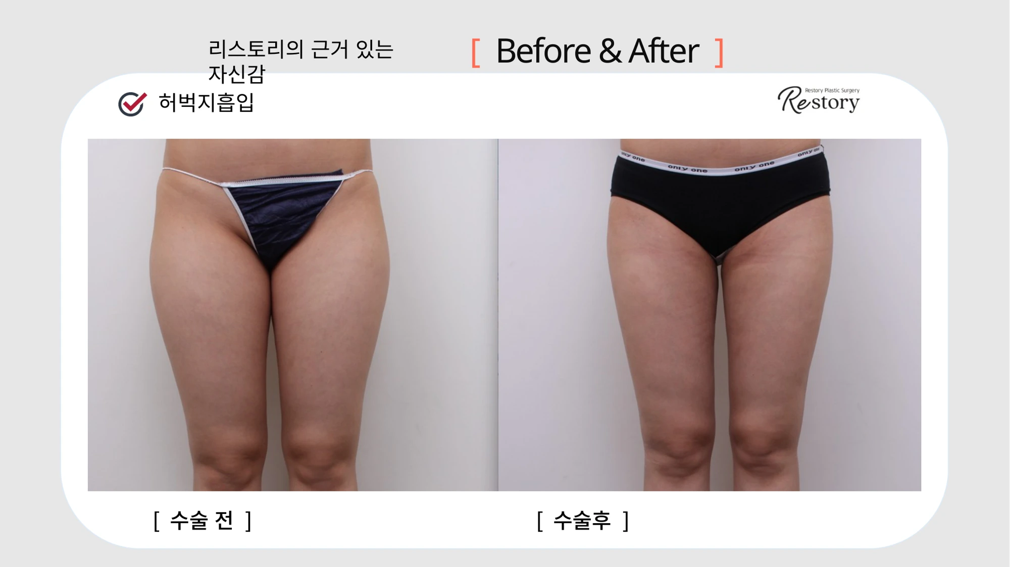 Thigh liposuction · 094 at Restory Plastic Surgery Clinic. Front thigh view. Before on the left; after on the right. The photographs show the inner and outer thigh contours. The follow-up interval is not stated.