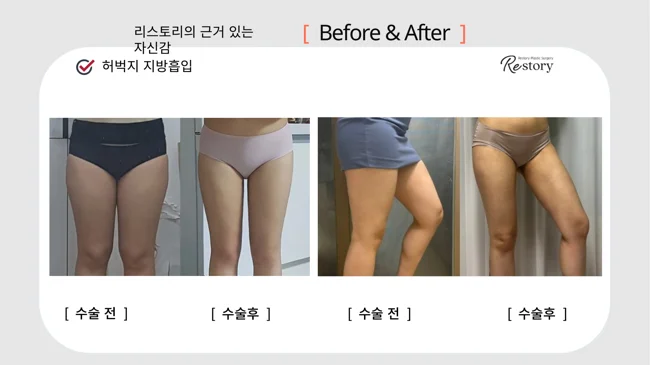 Thigh liposuction: front and angled comparisons · 095 at Restory Plastic Surgery Clinic. Front and angled thigh views. Two pairs: before and after from the front, followed by before and after from an angled view. The photographs show the inner and outer thigh contours. The follow-up interval is not stated.