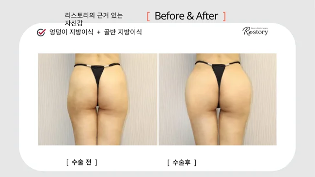 Buttock and hip fat grafting · 096 at Restory Plastic Surgery Clinic. Rear view. Before on the left; after on the right. The photographs show the hip and buttock contours from behind. The follow-up interval is not stated.