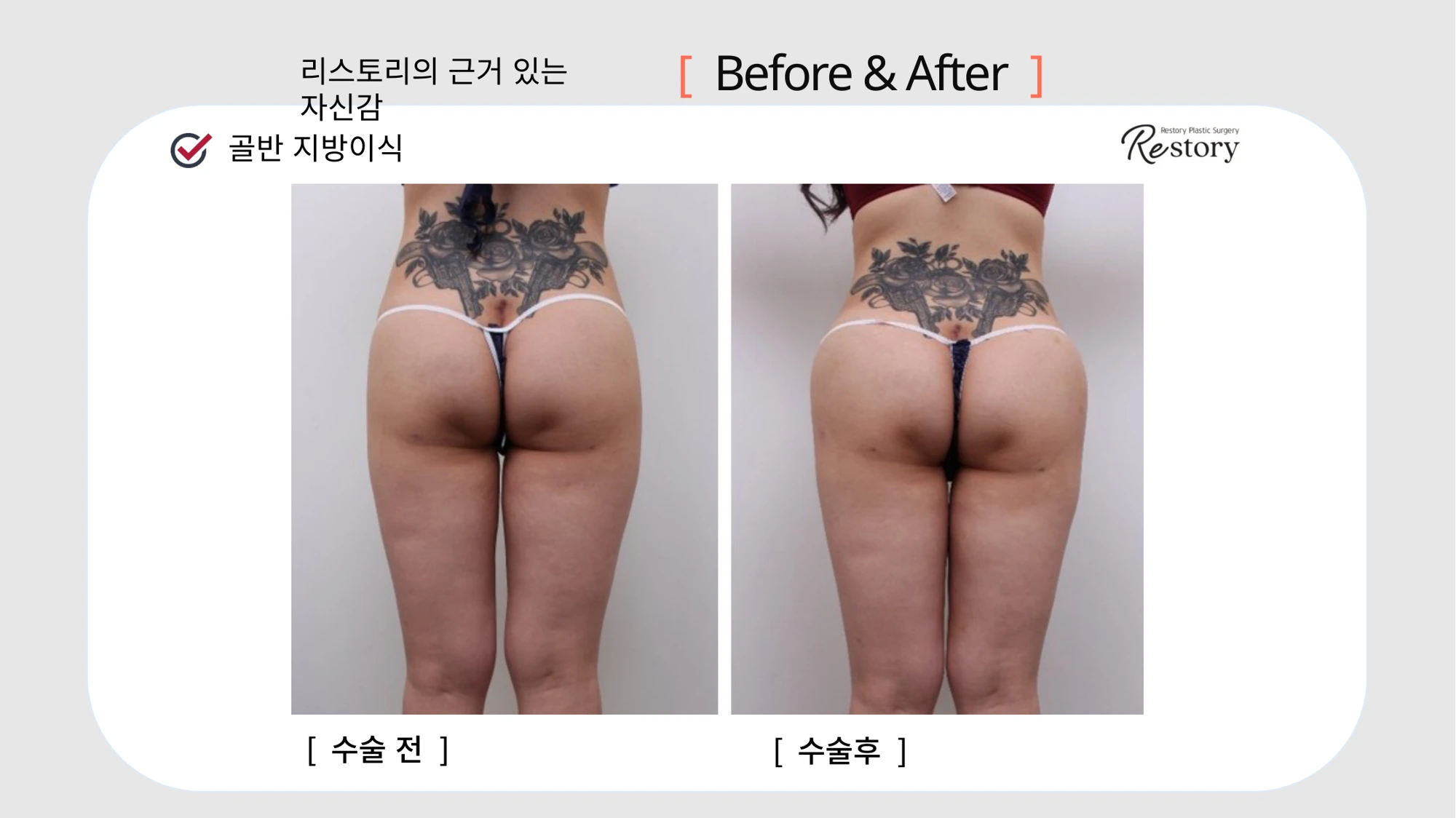 Hip fat grafting · 097 at Restory Plastic Surgery Clinic. Rear view. Before on the left; after on the right. The photographs show the hip and buttock contours from behind. The follow-up interval is not stated.