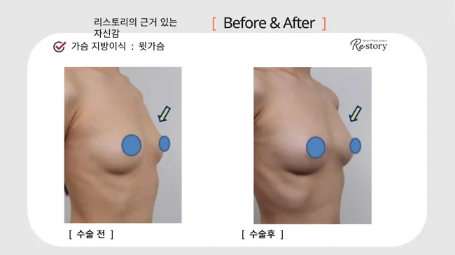 Upper-breast fat grafting · 098 at Restory Plastic Surgery Clinic. Angled breast view. Before on the left; after on the right. The photographs show the upper breast or inner breast contour. The follow-up interval is not stated.