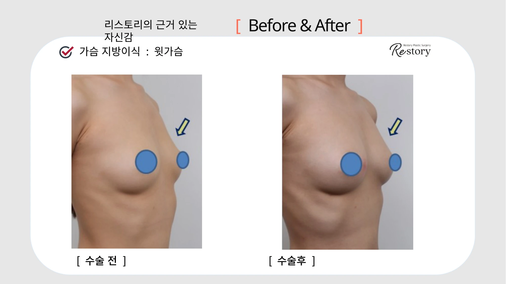 Upper-breast fat grafting · 098 at Restory Plastic Surgery Clinic. Angled breast view. Before on the left; after on the right. The photographs show the upper breast or inner breast contour. The follow-up interval is not stated.