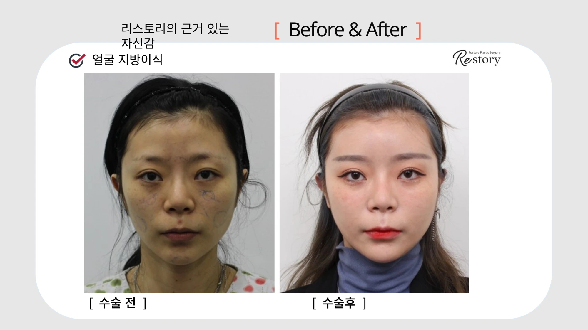 Facial fat grafting · 100 at Restory Plastic Surgery Clinic. Front view. Before on the left; after on the right. The photographs show the forehead, cheek and lower-face contours. The follow-up interval is not stated.