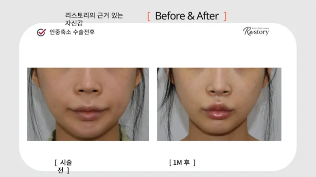 Philtrum reduction: lip-lift comparison · 102 at Restory Plastic Surgery Clinic. Lower-face close-up. Before on the left; after on the right. The photographs show the distance between the base of the nose and upper lip. The after photograph is labelled 1 month.