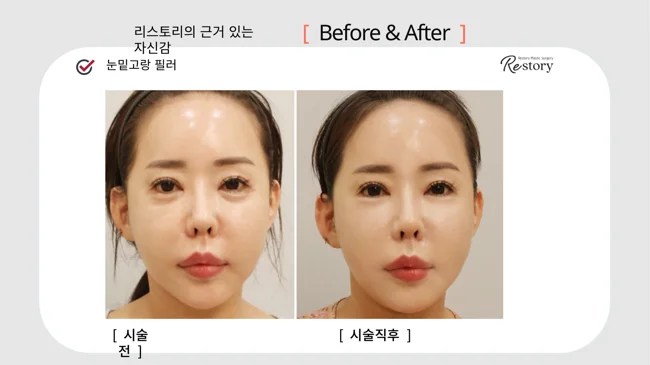 Tear-trough filler · 103 at Restory Plastic Surgery Clinic. Front view. Before on the left; after on the right. The photographs show the shape and surface of the area named in the treatment. The after photograph is labelled immediately after treatment.