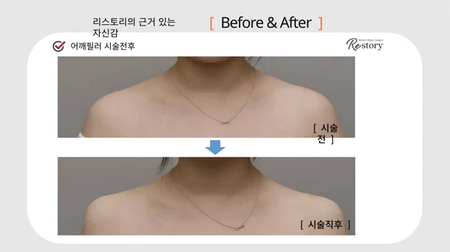 Shoulder filler: front view · 104 at Restory Plastic Surgery Clinic. Front shoulder view. Before above; after below. The photographs show the shape and surface of the area named in the treatment. The after photograph is labelled immediately after treatment.