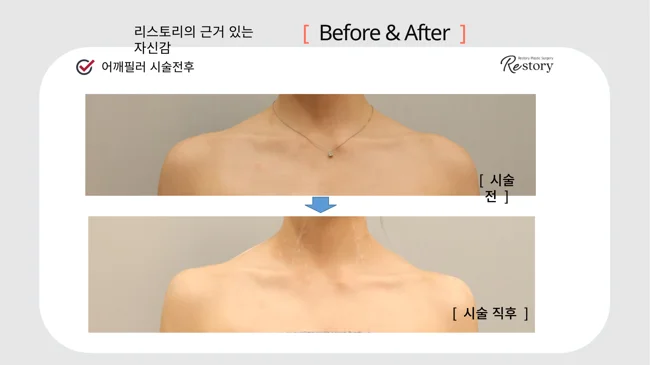 Shoulder filler: collarbone view · 105 at Restory Plastic Surgery Clinic. Front collarbone view. Before above; after below. The photographs show the shape and surface of the area named in the treatment. The after photograph is labelled immediately after treatment.