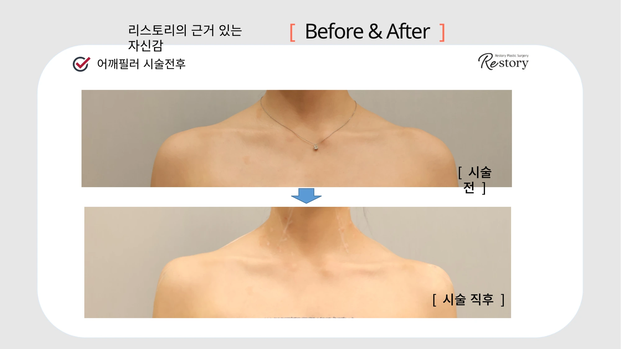 Shoulder filler: collarbone view · 105 at Restory Plastic Surgery Clinic. Front collarbone view. Before above; after below. The photographs show the shape and surface of the area named in the treatment. The after photograph is labelled immediately after treatment.