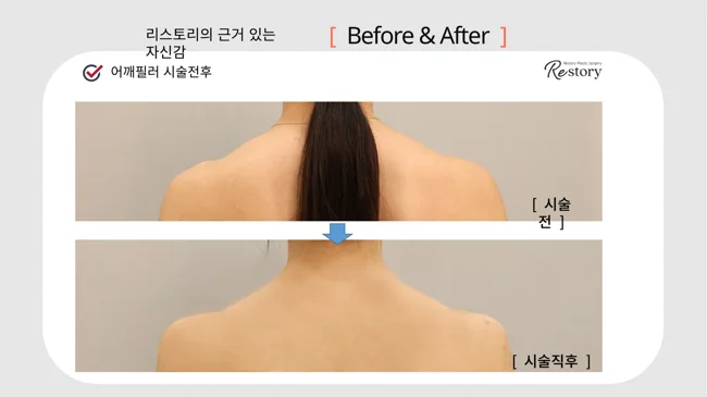 Shoulder filler: back view · 106 at Restory Plastic Surgery Clinic. Back shoulder view. Before above; after below. The photographs show the shape and surface of the area named in the treatment. The after photograph is labelled immediately after treatment.