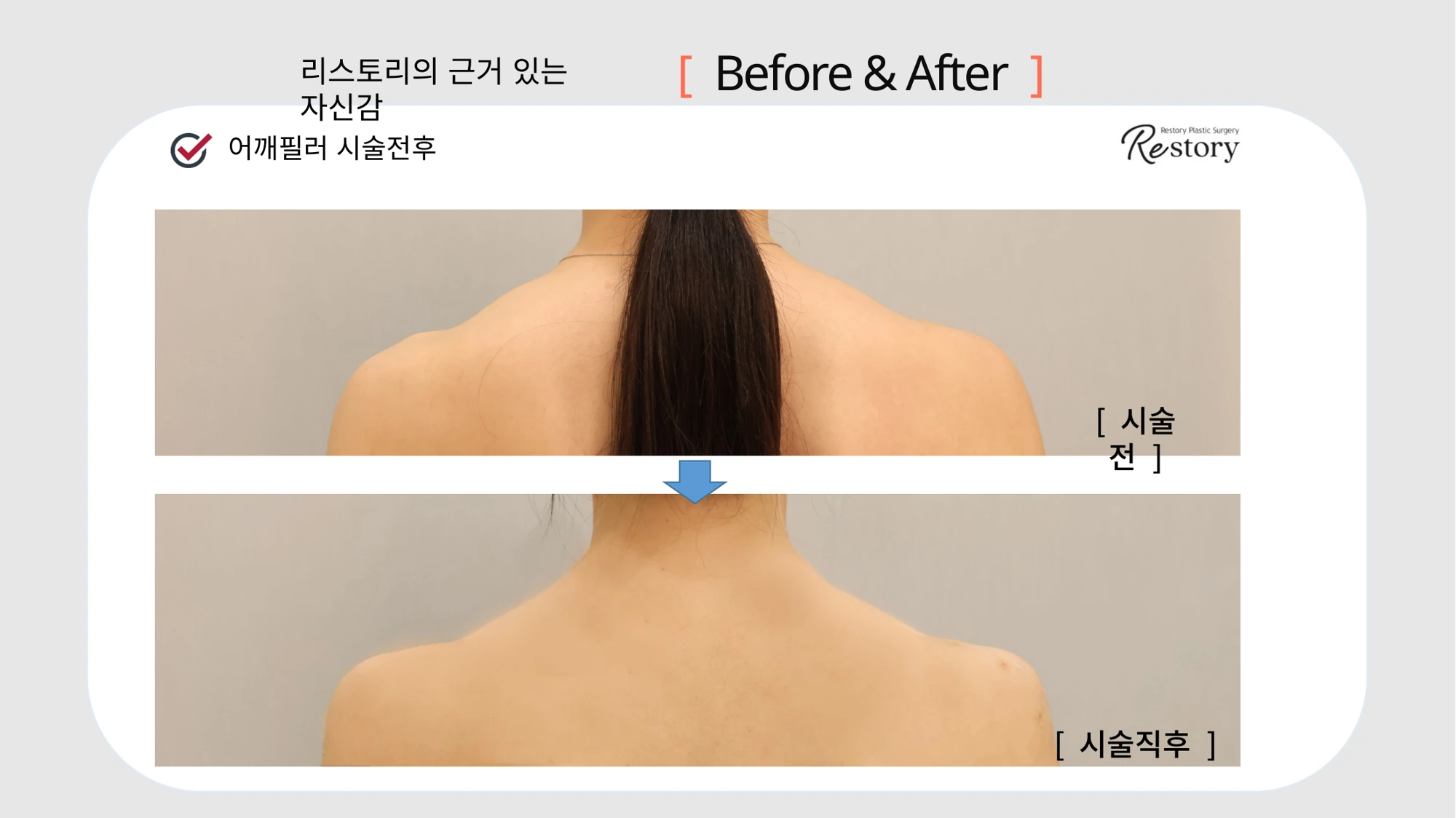 Shoulder filler: back view · 106 at Restory Plastic Surgery Clinic. Back shoulder view. Before above; after below. The photographs show the shape and surface of the area named in the treatment. The after photograph is labelled immediately after treatment.