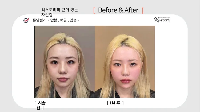 Cheek, chin and lip fillers · 107 at Restory Plastic Surgery Clinic. Front view. Before on the left; after on the right. The photographs show the shape and surface of the area named in the treatment. The after photograph is labelled 1 month.
