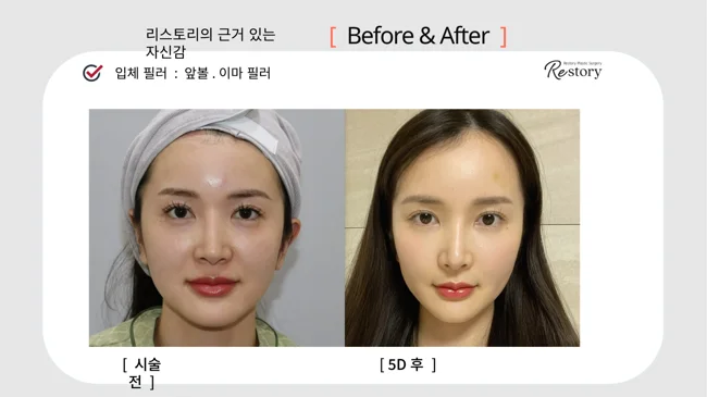Cheek and forehead fillers · 108 at Restory Plastic Surgery Clinic. Front view. Before on the left; after on the right. The photographs show the shape and surface of the area named in the treatment. The after photograph is labelled 5 days.