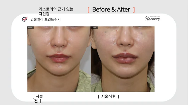 Lip filler · 109 at Restory Plastic Surgery Clinic. Lip and lower-face close-up. Before on the left; after on the right. The photographs show the shape and surface of the area named in the treatment. The after photograph is labelled immediately after treatment.