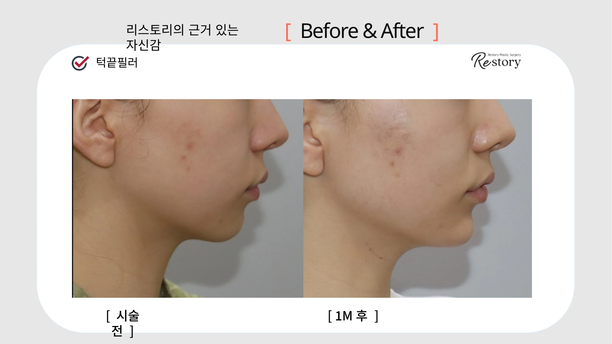 Chin filler · 110 at Restory Plastic Surgery Clinic. Chin side profile. Before on the left; after on the right. The photographs show the shape and surface of the area named in the treatment. The after photograph is labelled 1 month.