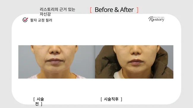 Nasolabial fold filler · 111 at Restory Plastic Surgery Clinic. Mouth-area close-up. Before on the left; after on the right. The photographs show the shape and surface of the area named in the treatment. The after photograph is labelled immediately after treatment.